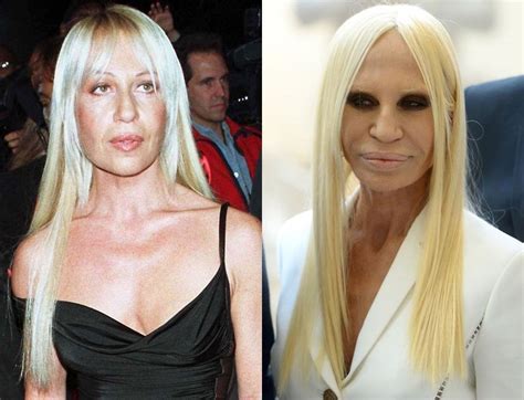 donatella versace e|donatella versace before and after surgery.